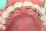 ortodonzia fissa estetica