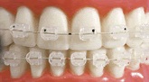 ortodonzia estetica